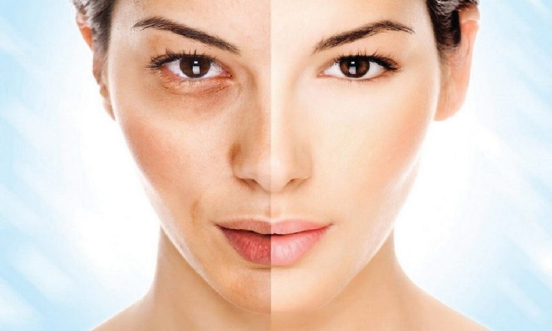 Melasma Treatments