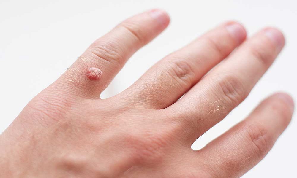 Wart Removal